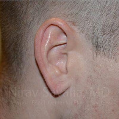 Case--1655727 | After Torn Earlobe Repair Ear Gauge Repair